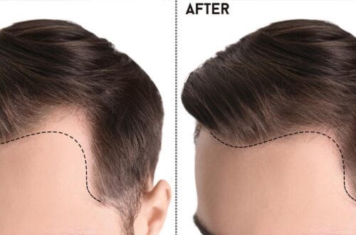 Best Hair Transplant in Islamabad