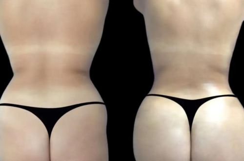 Why More People Are Opting for Non-Surgical Butt Fillers in Dubai