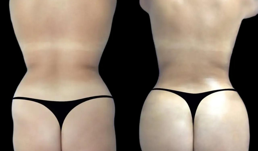 Why More People Are Opting for Non-Surgical Butt Fillers in Dubai