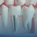 Dental implants in Lahore