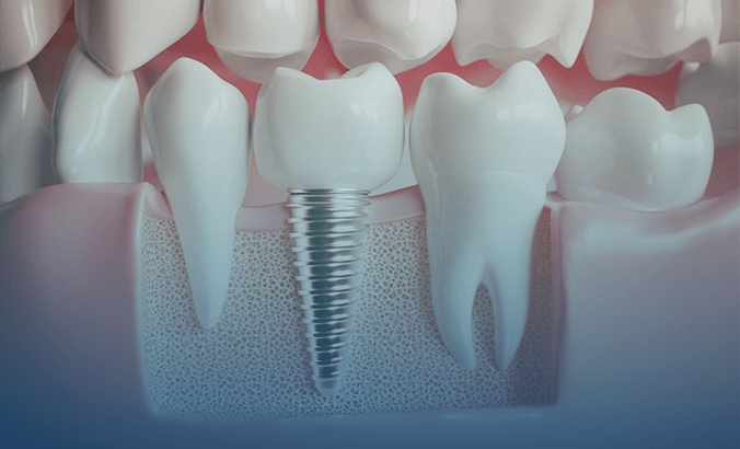 Dental implants in Lahore