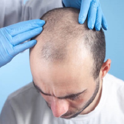 Hair Transplants in Dubai: What Does the Procedure Involve?