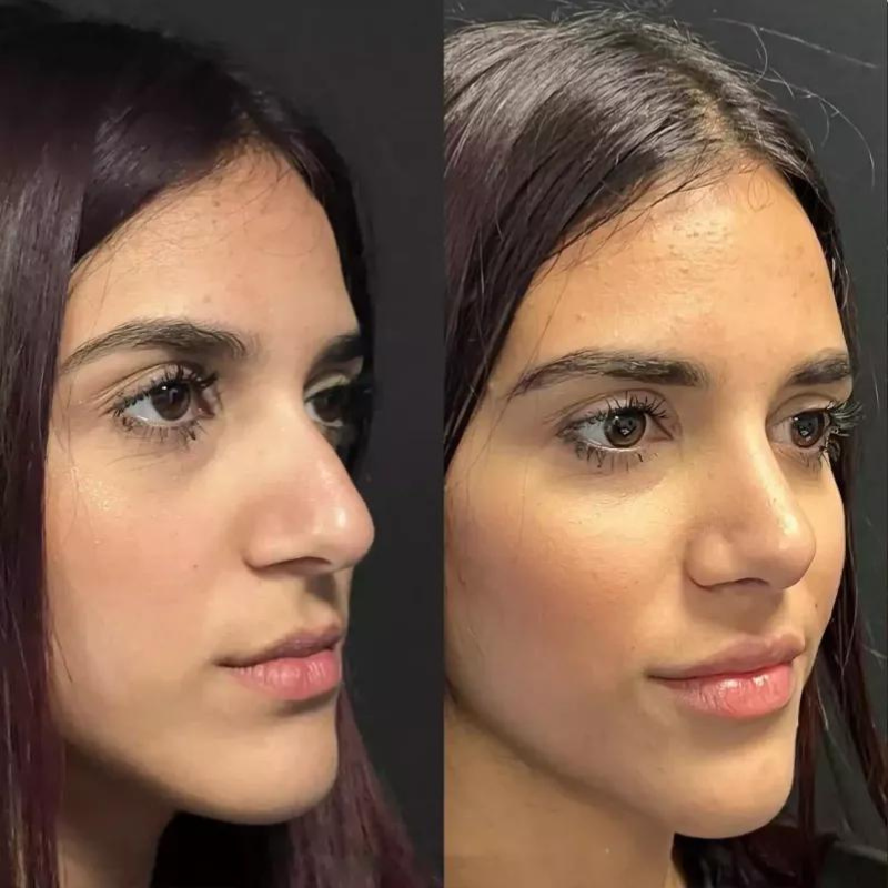 Final Results After Rhinoplasty in Dubai: How Soon?